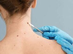 Aumentan en el mundo casos de cáncer de piel en los jóvenes